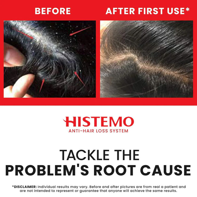 Histemo Hair Loss Prevention & Scalp Care Kit, Scalp Cleanser, Shampoo, Conditioner & Scalp Tonic, DHT Blocking Hair Restoration Treatment